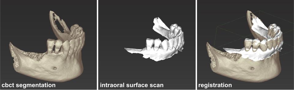 Fig. 4: Registration of CBCT and intraoral scan