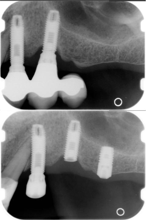 Fig. 6: Las fracturas de implantes ocurren con poca frecuencia, pero a menudo se asocian a condiciones que imponen cargas oclusales magnificadas al implante. Este ejemplo incluye un cantiléver distal de un segundo premolar como diente terminal. La dimensión limitada de este implante (3,75 mm) contribuye al riesgo de fractura. Téngase en cuenta que la solución a este problema pasa por la colocación de un implante corto en una posición distal para eliminar el cantiléver sin necesidad de retirar el implante fracturado