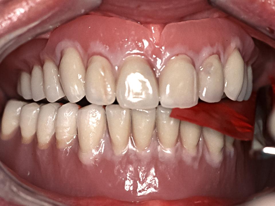 Fig. 7: Correzioni occlusali eseguite su una protesi completa esistente. Gli aggiustamenti occlusali eseguiti regolarmente possono essere importanti per prevenire il riassorbimento dell'osso mascellare, come indicato da De Souza et al. (2023) (Immagine per gentile concessione del Prof. em. Dr. med. dent. Karl-Heinz Utz)