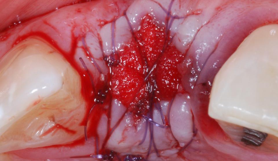 Abb. 10a: Alveolarkammerhalt + Typ-4-Implantation: Alveolarkammerhalt zum Zeitpunkt der Zahnextraktion.