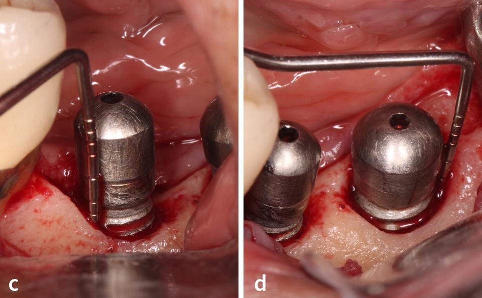 Fig. 2c - d: Upon flap reflection of the #19,20 implants, a class IIIc peri-implant bony defect (circumferential defect and horizontal bone loss) was identified (Monje et al. 2019)