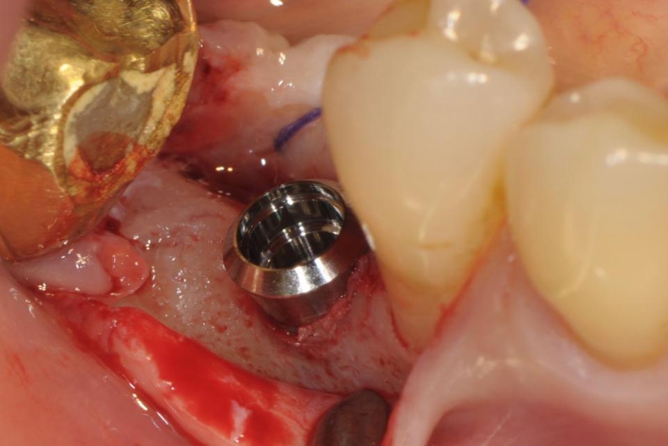 Fig. 3e: Buccal view of the implant placed