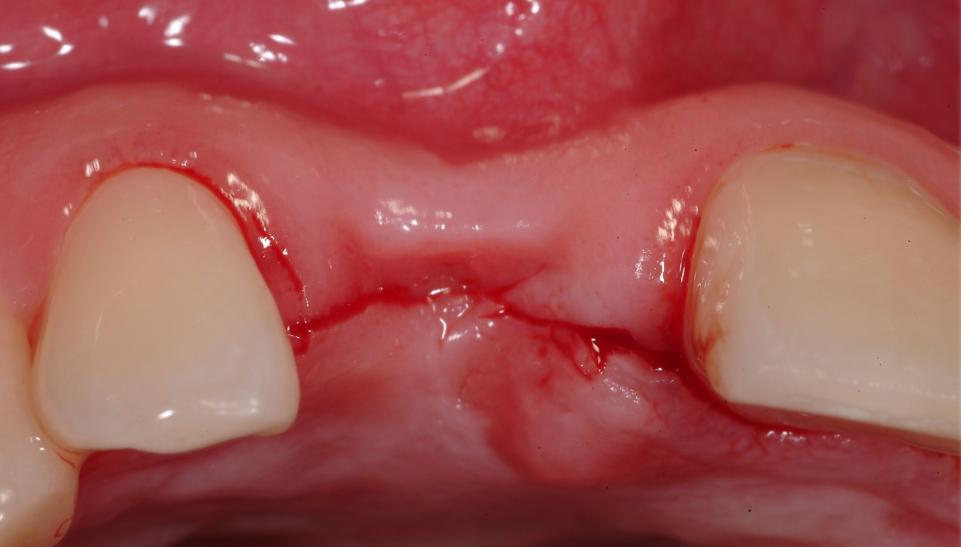 Fig. 9a: Colocación de implante tipo 2: Incisión en la cresta media

