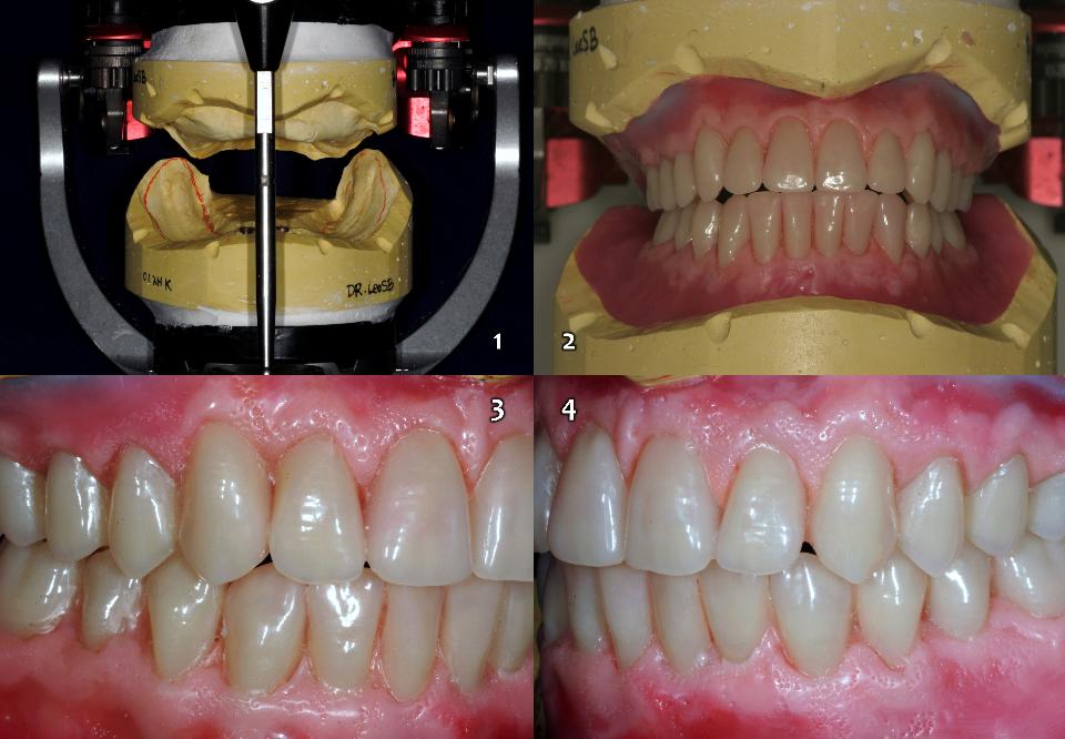 Fig. 15a: Opções de tratamento como 3ª prioridade (Figura 5). Um procedimento típico para fornecer uma prótese total convencional na maxila edêntula e uma overdenture sobre 2 implantes para o maxilar edêntulo inferior com o tipo flexível de fixação magnética (Magfit-SX800, Aiichi Steel). (1: Modelos de trabalho superior e inferior montados no articulador dentário semi-ajustável tridimensionalmente; 2: Disposição dos dentes artificiais de acordo com o suporte estético do lábio do paciente e no plano oclusal adequado; e 3 – 4: Finalização da formação da gengiva em cera).