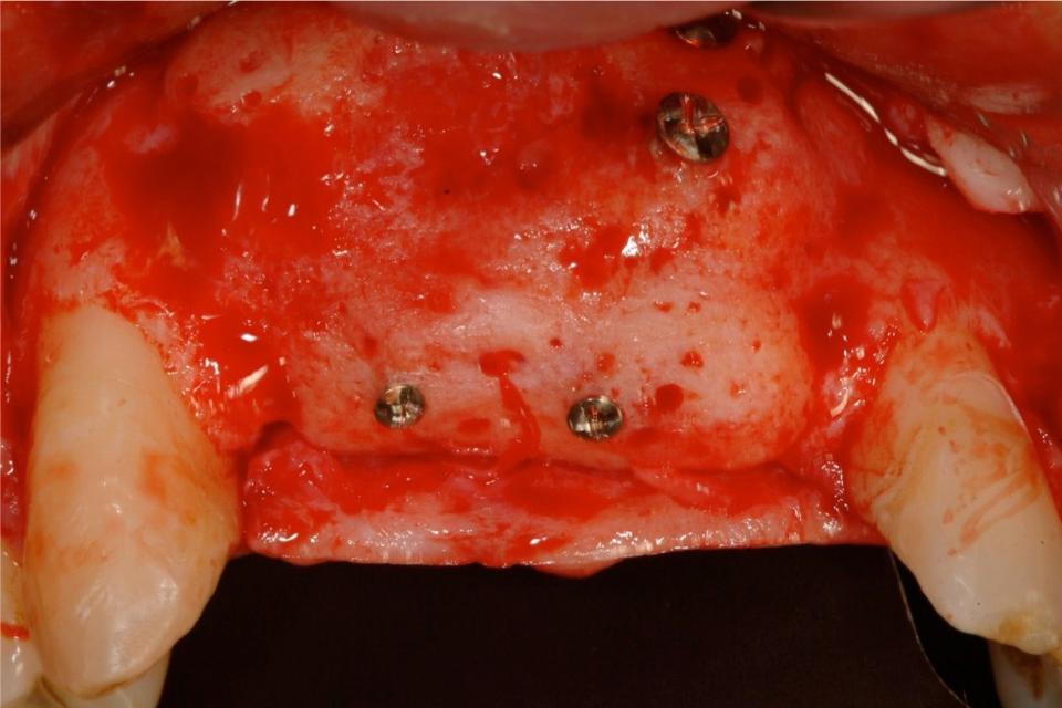 Fig. 4h: Intraoperative view, buccal aspect, at implant placement (Straumann TE, 3.3 x 12 mm for central incisors, Straumann Narrow Neck 3.3 x 10 mm for lateral incisor)