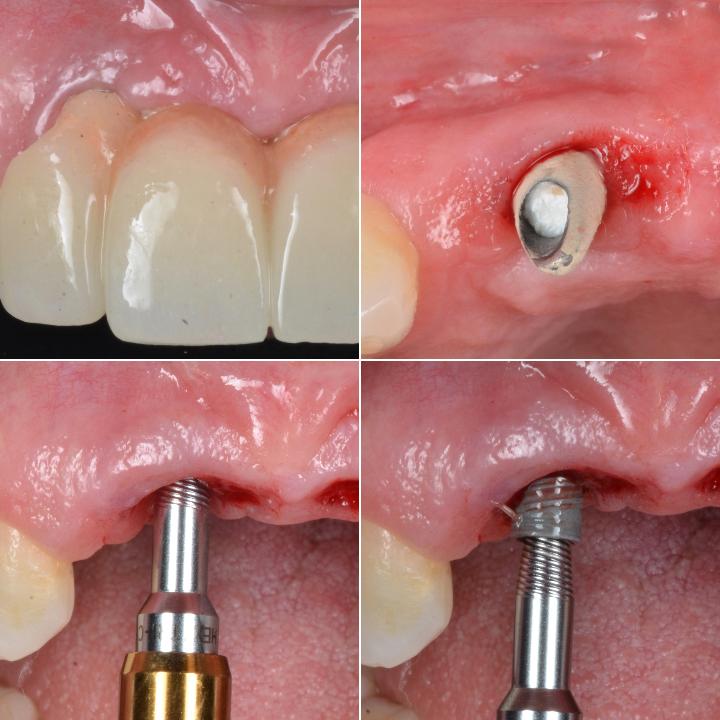 図3: 審美的な合併症をともなう症例では、インプラントが歯槽骨とよく統合されているため、リバース・エンジニアリングを用いたインプラント撤去ツールの使用がしばしば必要となる。この症例の場合、適切に補綴主導で埋入されたインプラントが、良好な審美的結果をもたらしていない。