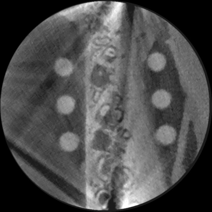 Fig. 6: Cone-beam computed tomography axial reconstruction of a porcine mandible revealing bright streaks and dark bands generated by three dental implants located in the exomass: one anterior, one posterior, and one on the contralateral sideCone-beam computed tomography axial reconstruction of a porcine mandible revealing bright streaks and dark bands generated by three dental implants located in the exomass: one anterior, one posterior, and one on the contralateral side