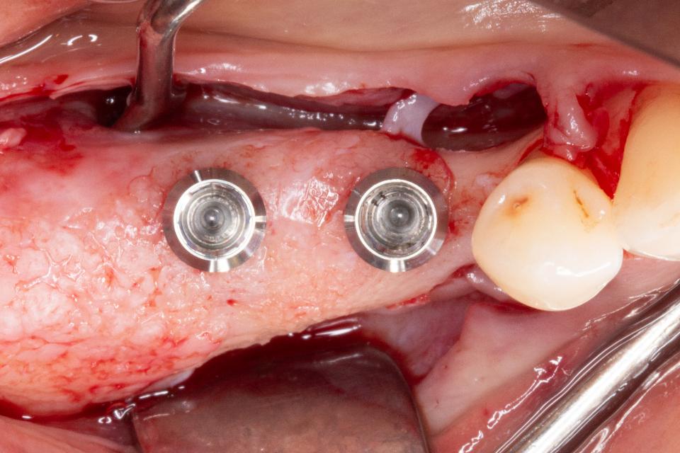 Fig. 1g:  Occlusal view of two implants placed (Straumann Tissue Level, SLA, 4.1 x 6 mm)