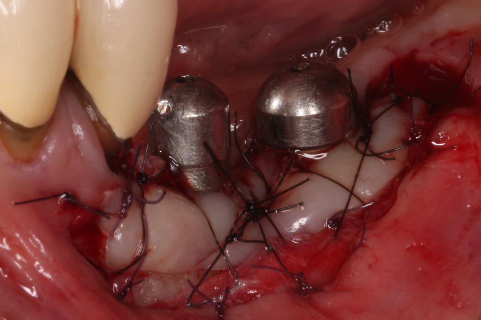 Fig. 2j: Une greffe gingivale libre a été réalisée après un an de suivi post-opératoire.