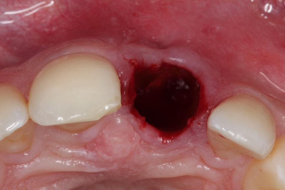 Fig. 4: Extraction socket immediately following tooth extraction left for spontaneous healing