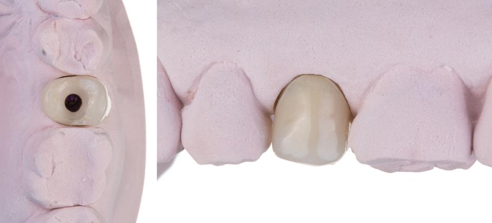 Fig. 3m: Completed provisional seated onto the cast with the gingival margin of the extracted tooth closely approximated with the contours of the restoration, which will provide a mechanical barrier to prevent loss of the graft material whilst supporting the pre-extraction soft tissue architecture