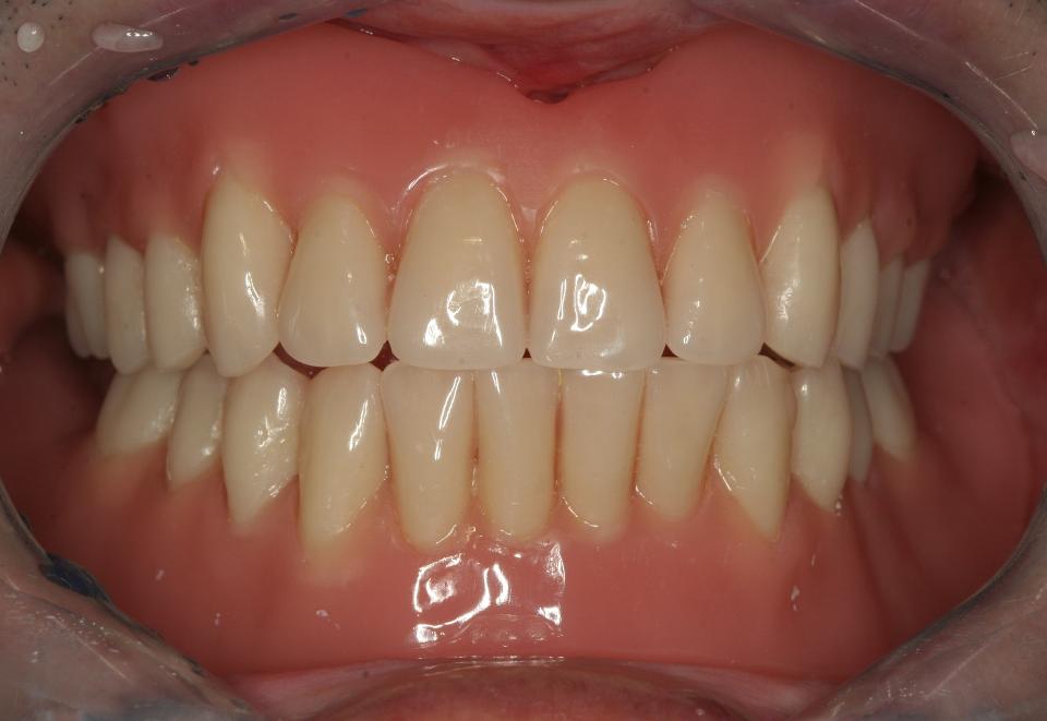 Fig. 15c: The fabrication of upper and lower acrylic dentures containing the PEEK frameworks as a reinforcement structure inside the denture bases was completed