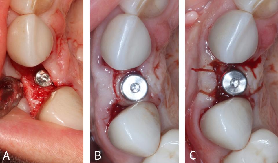 Fig. 10: Uso de FRP na fase de abertura do implante, conhecida como “técnica do poncho” na região #7 . (A) Incisão na crista média com retalho de espessura total refletido mostrando osso vestibular adequado no local do implante nº 7. (B) Pilar de cicatrização fixado na plataforma do implante por meio de uma membrana sólida de FRP. (C) Sutura final. (Caso realizado pelo Dr. Nathan Estrin).