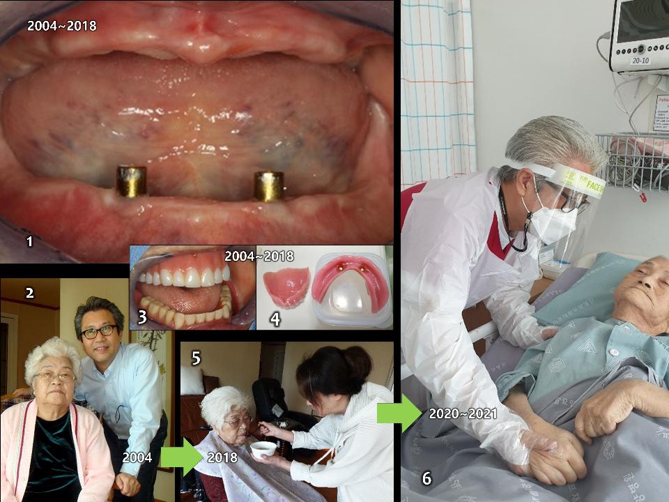 Fig. 3: For those aged 65 and over, removable dentures that can be inserted and taken out are better than fixed bridges, right? In dental treatment for elderly patients aged 65 or older, we should predict and prepare for the progression of hand disorders, behavioral disorders, activity disorders, and cognitive disorders over time. My mother wore upper CD & lower 2-implant OVD (1 - 5) provided by me, from 2004 (76 years old at the time) to 2021. The removable dentures worked very well for 16 years. However, as hand disorders, mobility disorders, and activity disorders worsened after 2018, she was unable to use them well on her own, and in the last year until her death in 2021 (aged 93), the upper CD & lower 2-implant OVD were of no use as she was fed by intravenous infusions (6). I regret not making a treatment plan to provide my mother with fixed implant restorations when I began treatment planning for her in 2004
