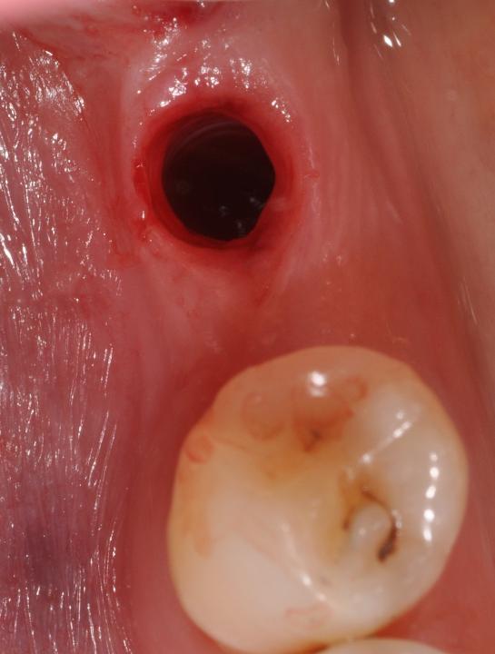Fig. 2: Aseptic loosening of a two-piece zirconia implant