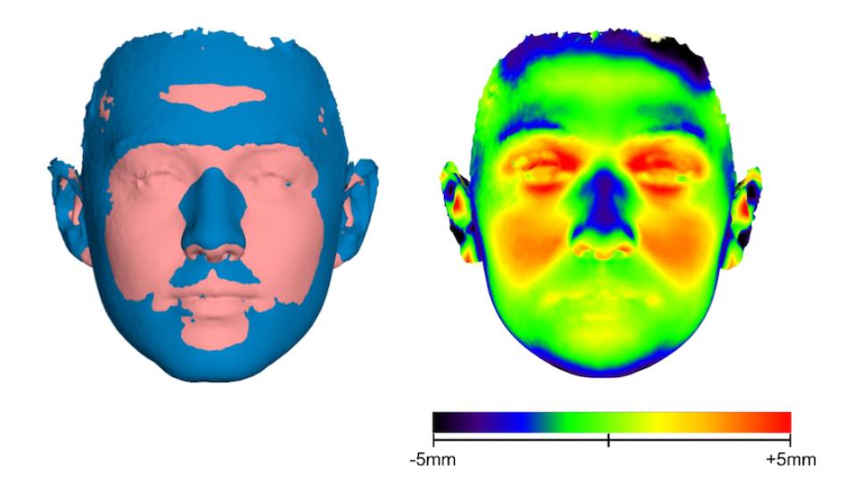Şekil 3: Erkekler ve kadınlar arasındaki yüz şeklindeki yüzey farklılıklarını gösteren en uygun çakıştırma. Renk haritası (sağ alt), bu farklılıkların büyüklüğünü kadının erkek yüzünden uzaklığı olarak gösterir (pozitif: ileri). (Kanavakis, G., Halazonetis, D., Katsaros, C. ve Gkantidis, N.'den modifiye edilmiş görüntü (2021))