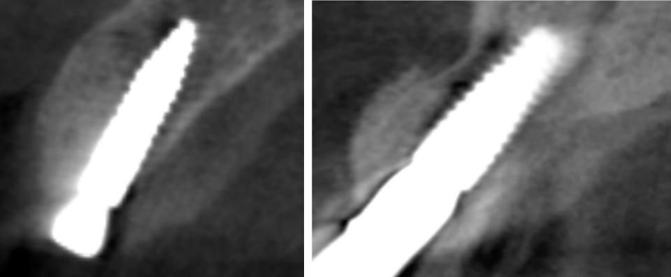 Fig. 13: Tomografia Computadorizada de Feixa Cônico (TCFC) pós-cirúrgica de dois casos diferentes de instalação de implantes em associação com ROG demonstrando osso vestibular estável. Esquerda: pós-operatório imediato da instalação do implante tipo 1. À direita: acompanhamento de 6 anos da instalação de implantes tipo 2