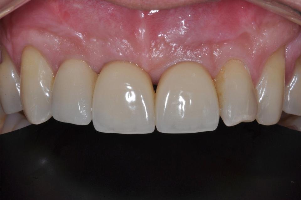 Fig. 4i: Buccal view, final screw-retained restorations, 5 years after loading. Single crowns (restoration by Dr. Joao Emilio Roehe Neto, Porto Alegre, Brazil)