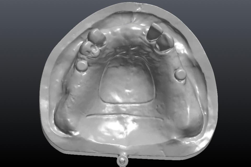 Fig. 45: When the dynamic soft tissue movement is critical for a removable implant-retained prosthesis, a traditional impression should be made for optimal clinical outcomes. An analog cast can be digitalized in the dental laboratory with a laboratory scanner