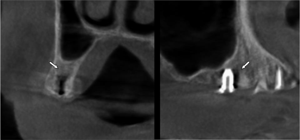 Fig. 9: Reconstruction frontale (a) et sagittale (b) de la région postérieure du maxillaire droit d’un patient porteur d’un implant dentaire à partir d’images de tomographie à faisceau conique. Les flèches blanches indiquent la dégradation de l’image autour de l’implant, qui empêche la bonne évaluation de son contact avec l’os.