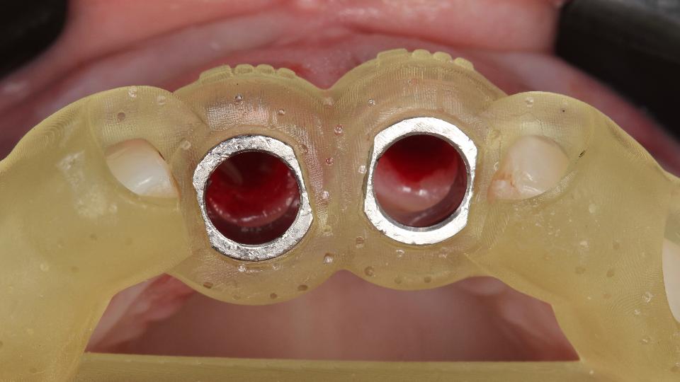 Fig. 6b: Type 1a protocol – occlusal view after extraction and with the printed surgical guided in position