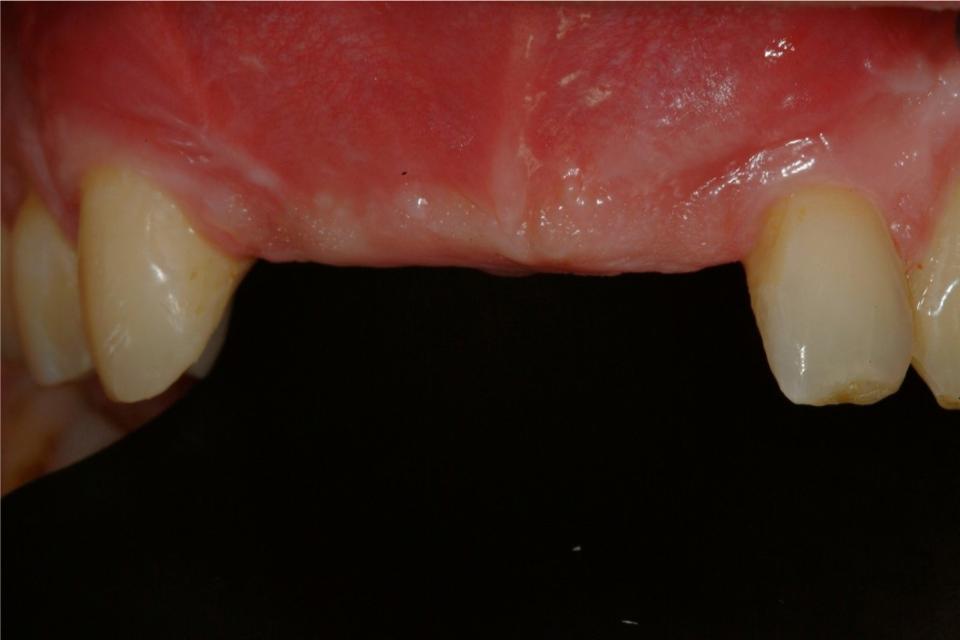 Fig. 4g: Clinical view, buccal aspect, 5 months after grafting, pre-operatory of implant placement