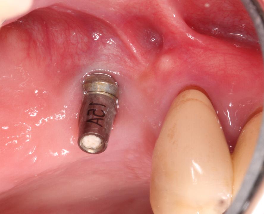 Fig. 3b: Implant prosthesis was removed in the hygienic phase. No mobility of the implant could be detected