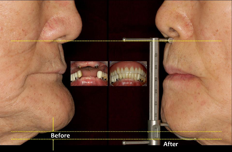 図10k: 歯科医師は、患者の本来の審美的な質を再現または改善するため、各患者が求める審美的特性を理解できなければならない。単純な例でいえば、西欧人と韓国人の側貌には大きな違いがある。西欧人は側貌に凹状の特徴がある。多くの韓国人の唇は、鼻の先端と顎の先端を結ぶ線よりもわずかに突出しているため、全体として凹状の側貌にはならない