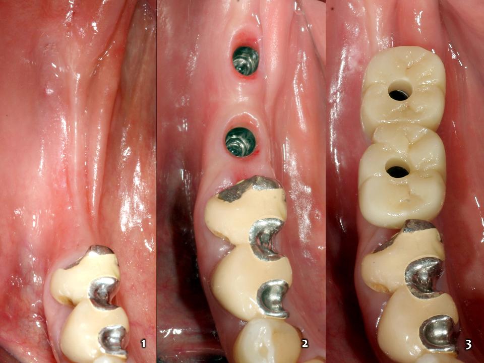 図2: 下顎右側第一および第二大臼歯部位のコンピュータ支援インプラント手術と、CAD/CAMモノリシックジルコニアを用いたスクリュー固定式インプラント補綴の埋入後結果。可撤式補綴を12年間使用してきた患者が、固定式インプラント補綴への変換を希望。インプラント補綴が、下顎右側の天然大臼歯と同じ機能をもたらした （1～3）。