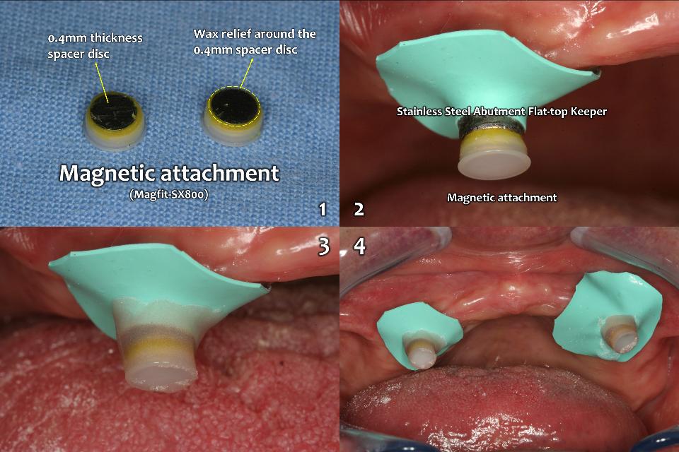 Fig. 10b: A prosthodontic option and retentive devices for the IOVD that elderly disabled patients can handle well should be selected. 2 magnetic attachments (Magfit-SX800, Aiichi Steel) for 2 implants overdenture on upper edentulous jaw were selected in this case (Fig. 10a)