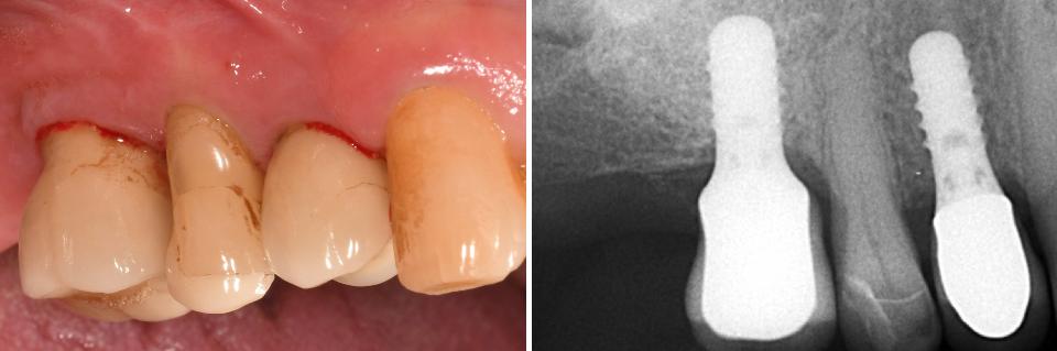 Fig. 1a: Mucositis case exhibiting bleeding on probing, probing pocket depths (≤ 5 mm and no radiographic bone loss)