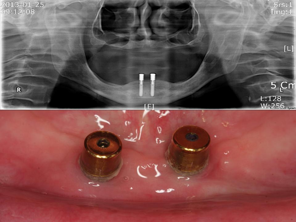 Fig. 15h: Conventional complete denture on upper edentulous jaw and 2-implant (TL, retained overdenture for the lower edentulous jaw with the flexible type of magnetic attachment (Magfit-SX800, Aiichi Steel) can be provided as the lowest cost and patient-friendly treatment option (1 - 4). The upper CD and lower magnetic IOVD are working very well until now since 2013