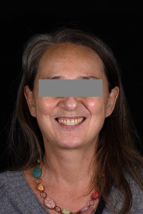 Fig. 5b: Sorriso gengival extraoral após tratamento – vista frontal