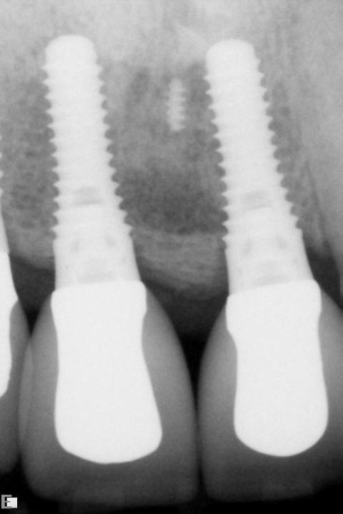Fig. 4j-2: Periapical radiographs, 5 years after loading