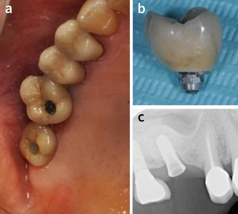 Fig. 3: Six months post-restoration, implant crown 16 was slightly mobile in a bucco-palatal direction, with the dislocation of the crown of no more than 1 mm. While attempting to unscrew the crown with the wrench, the crown rotated approximately 30° counterclockwise without releasing the abutment screw (a), indicating that the implant was spinning in the bone socket. After the crown was removed (b) the periapical radiograph showed no signiﬁcant change in the bone height from that of the baseline, note however the consistent thin layer of radioluscency all around the implant 16 (c)