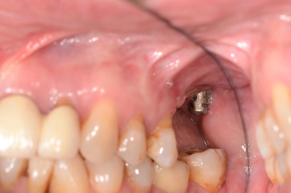 Şekil  3: 17 numaralı diş bölgesine yanlış pozisyonda yerleştirilen implant, optimal olmayan peri-mukozal yumuşak doku koşullarına neden olur. 