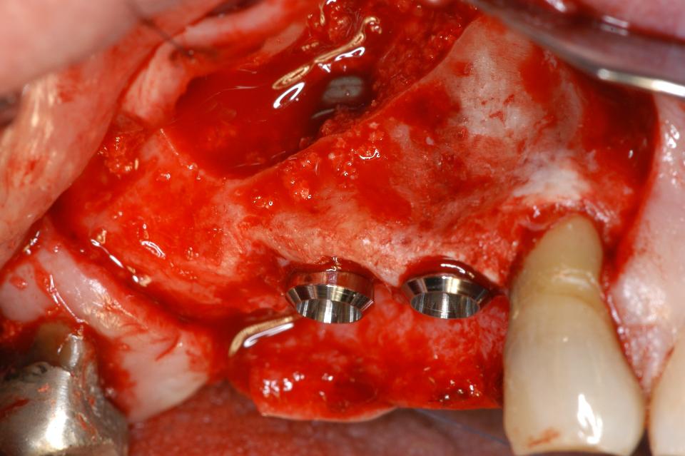 Fig. 6c: Following application of the first portion of a composite graft, two TL implants were inserted. As usual, the border to the SLA surface was located 1 - 2 mm below the crest