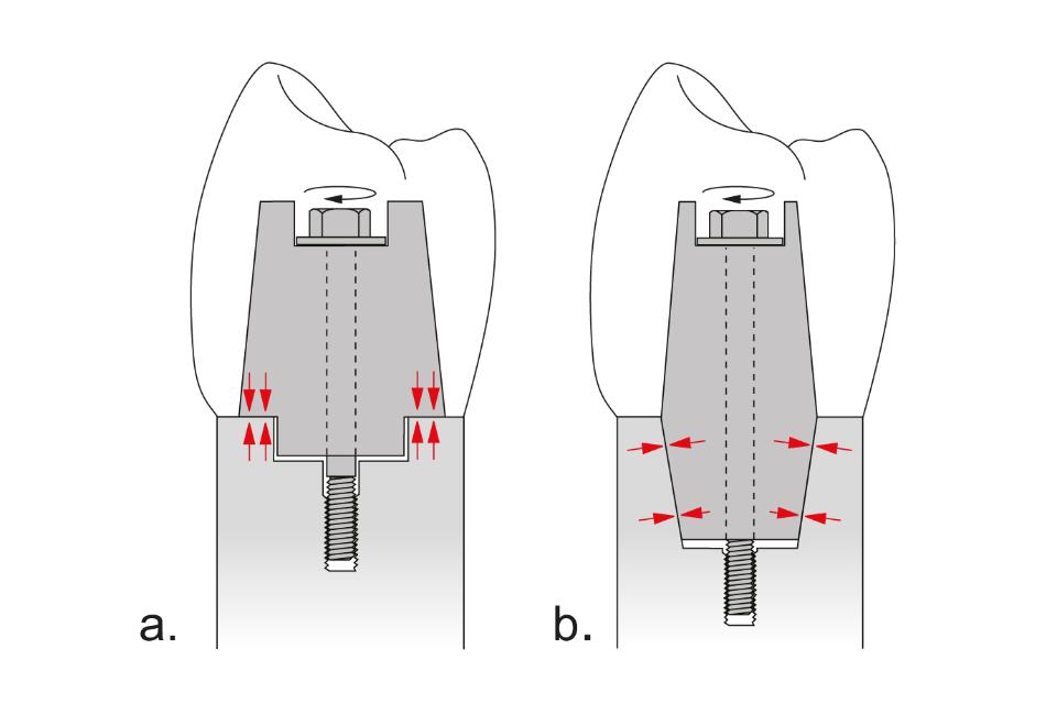 Fig. 4: Force transmission. Force transmission takes place on the horizontal surfaces (a: Brånemark prototype) or along the oblique walls of the cone (b: Straumann prototype)