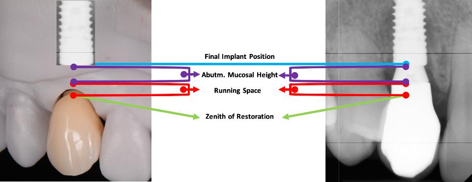 Fig. 6: Représentation graphique de la formule utilisée pour déterminer la position idéale de l'implant dans la zone esthétique : Limite la plus coronaire de la restauration prévue (vert) + espace de fonctionnement (rouge) + hauteur muqueuse du pilier (violet) = position verticale de l'implant (bleu).