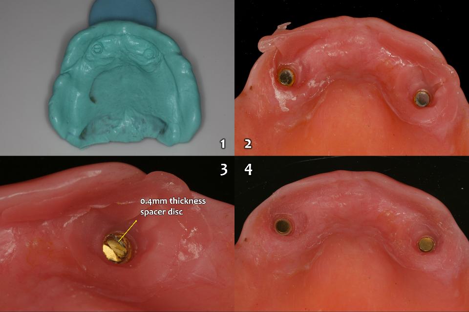 Fig. 10c: Manufacture of new maxillary denture and installation of 2 magnetic attachments (Magfit-SX800, Aiichi Steel). 1: the silicone rubber impression including the 2-implant abutment keepers for the magnetic devices; 2: just after intraoral cementation with acrylic pink resin of the magnetic attachments; 3: removed 0.4mm thickness spacer disc from the top of the magnetic attachment; and 4: completed 2-implant magnetic OVD