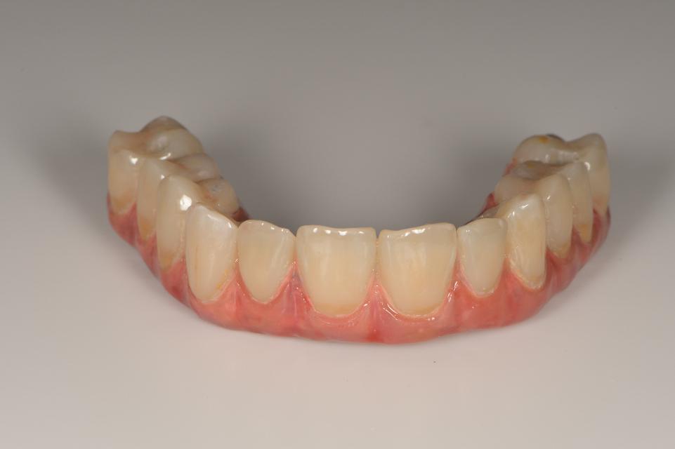 Fig. 9: Prothèse dentaire complète sur implant avec armature métallique et couronnes individuelles en zircone.