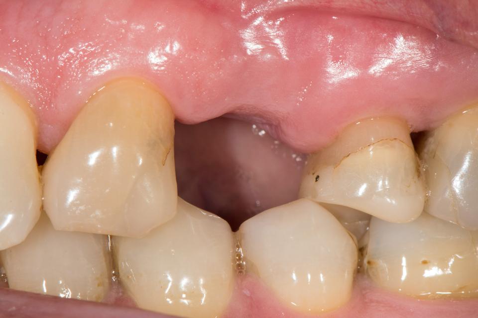 Şekil 4a: Klinik vaka 1: Tek parça zirkonya implant destekli tek kuron. Hasta, çekilmesi gereken 24 numaralı dişle başvurdu ve metal içermeyen bir tedavi seçeneği istedi. Çekimden 8 hafta sonra klinik durum. (Fotoğraf: Stefan Roehling)