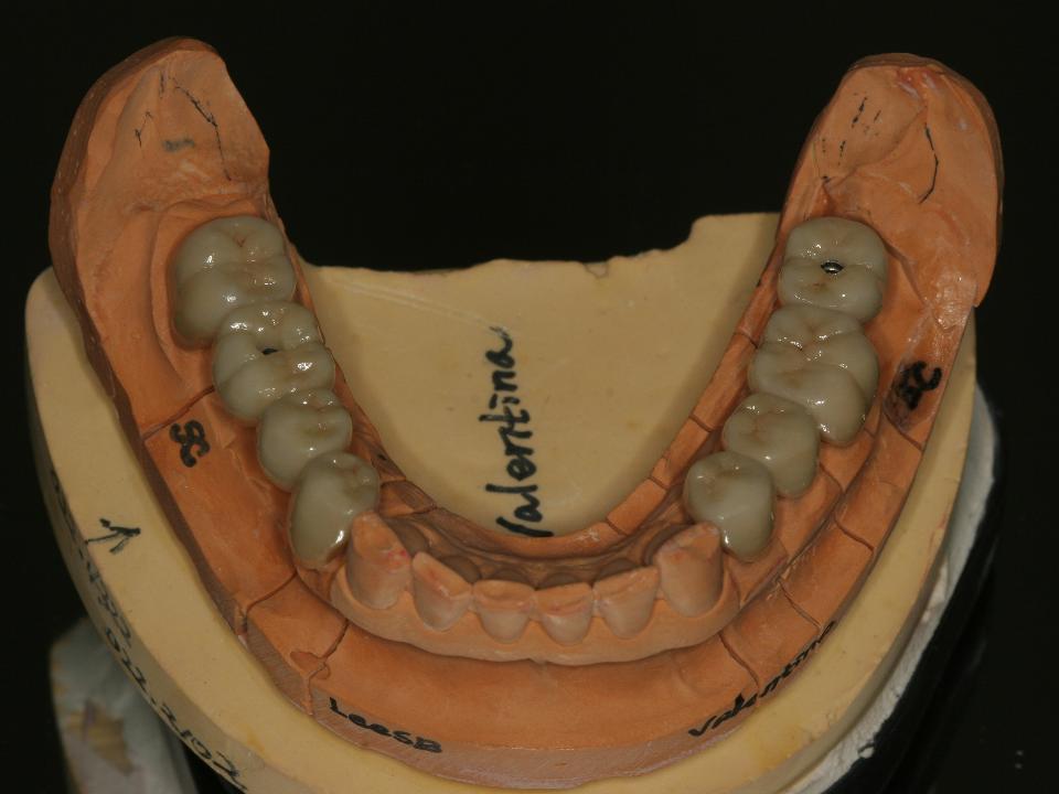 図6h: 第二CAD/CAMワークフローによる、下顎ジルコニア補綴装置 （Prettau、Zirkonzahn、Gais）。下顎右側第一大臼歯と左側第二大臼歯の部位のインプラント上のスクリューリテインタイプの固定式ジルコニア最終補綴装置と、天然歯のジルコニアクラウン