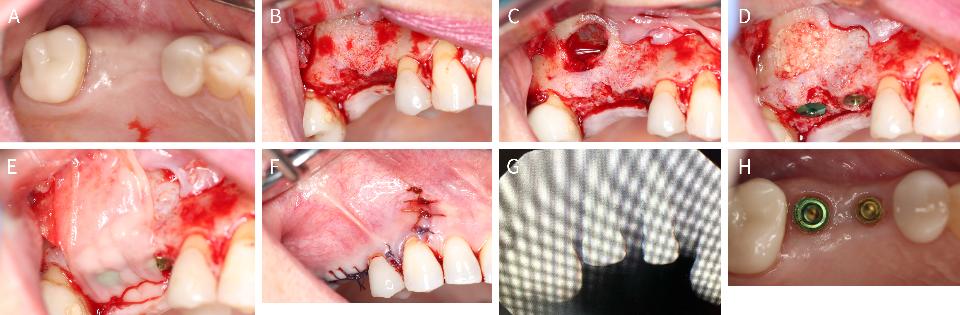 Fig. 9: Elevação do assoalho do seio lateral e membrana de FRP  com colocação do implante. (A) Vista oclusal da região #3 e #4. (B) O retalho de espessura total foi elevado, mostrando a área onde a janela lateral será preparada. (C, D) A elevação do assoalho do seio foi concluída, a osteotomia foi preparada e o implante #14 foi colocado em conjunto com osso pegajoso utilizando enxerto de osso alógeno particulado misturado com FRP sólida e líquida. (E) A membrana de colágeno foi posicionada sobre o acesso à janela lateral e coberta com membranas de FRP sólida posicionadas sob a linha de incisão. (F) Ferida cirúrgica suturada com suturas de monofilamento Vicryl na área edêntula e incisões de liberação verticais fechadas com suturas. (G) Radiografia pós-operatória de 6 meses no momento do segundo estágio. (H) Cicatrização do tecido mole antes das restaurações finais. (Caso realizado pelo Dr. Nathan Estrin).