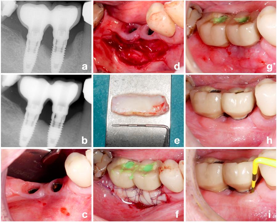 Fig. 9: Patient case with peri-implantitis at the implant in position #45 (a) successfully treated with a reconstructive approach (b), but remaining bleeding on probing at the buccal aspect with a minor amount of keratinized, attached peri-implant mucosa (c). An apically positioned flap (d) and placement of a free gingival graft was performed (e-f); at suture removal a well-integrated soft tissue graft was observed (g). The procedure resulted in a stable post-operative result with a significant increase in the width of keratinized, attached peri-implant mucosa (h - i)