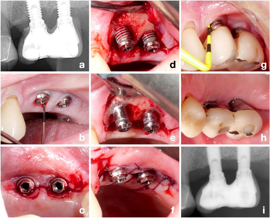 Fig. 4: Patient case with peri-implantitis at the implants in position #25 and #26 (a - b) treated by a non-augmentative approach. A paramarginal incision palatally and a sulcular incision buccally were performed (c) and after flap elevation primarily horizontal bone loss with a minor bone peak between the implants was recognized (d). Implantoplasty and bone re-contouring were performed (e), the palatal flap was thinned and both the buccal and the palatal flaps were apically positioned and sutured (f). The procedure resulted in a stable post-operative result (g - i), although the patient refused an additional surgery to increase the width of keratinized, attached peri-implant mucosa (g)
