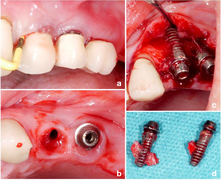 Fig. 2: Although the primary treatment plan was to keep the implants in position #24 and #25 (a - b), it became obvious during surgery that explantation was a more favorable treatment option due to extensive peri-implant bone loss in combination with malpositioning of the implants (c - d)