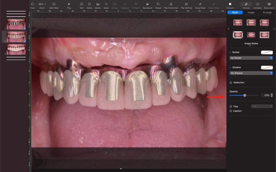 Fig. 9: Aparência semitransparente da foto do protótipo das coroas, mostrando um belo encaixe do protótipo e possibilitando a análise da necessidade de novas modificações