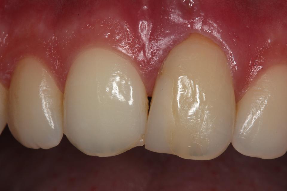 Fig. 1: Clinical situation with a failing central incisor