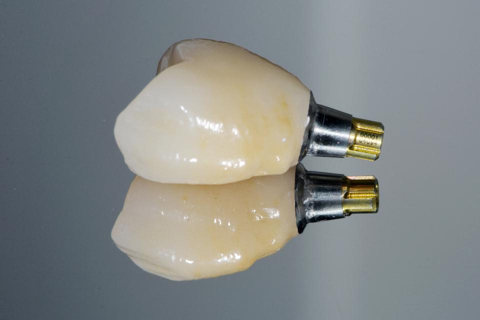 Fig. 3a: Monolithic zirconia crown with aesthetic coloration on the buccal aspect